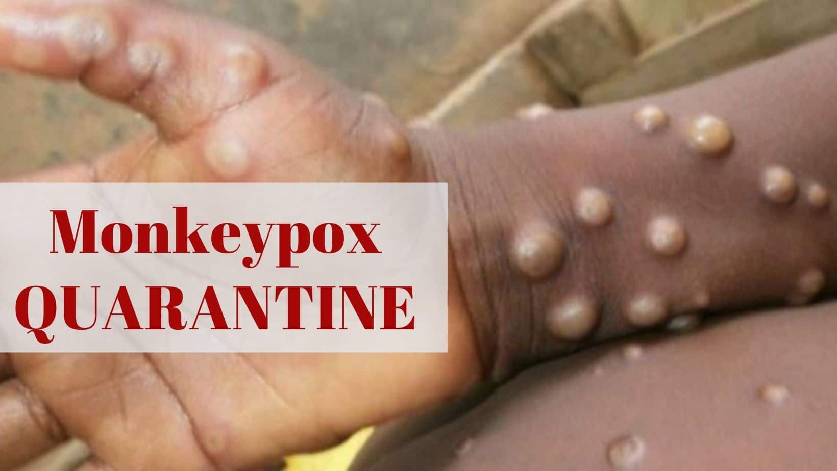 Belgium Becomes First Country To Introduce Monkeypox Quarantine As Virus Spread To 12 Countries